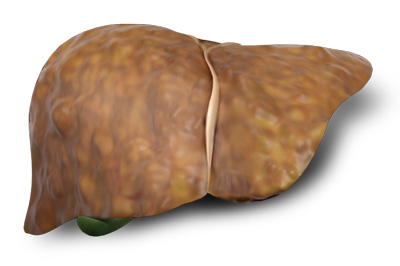 Cirrhosis-web