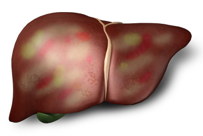 Hepatitis-web